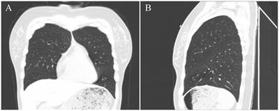 Case Report: Hemangioblastoma- Like Clear Cell Stromal Tumor of the Left Lower Lung